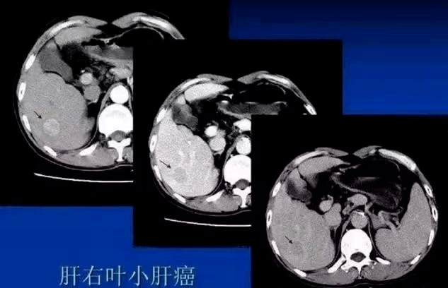 肝左叶小结节，解读与应对策略